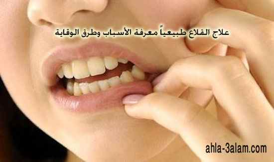 علاج القلاع طبيعياً معرفة الأسباب وطرق الوقاية