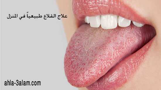علاج الحمو وجفاف الفم طبيعياً