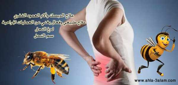 علاج الديسك طبيعي بلدغ النحل تغنيك عن الجراحة