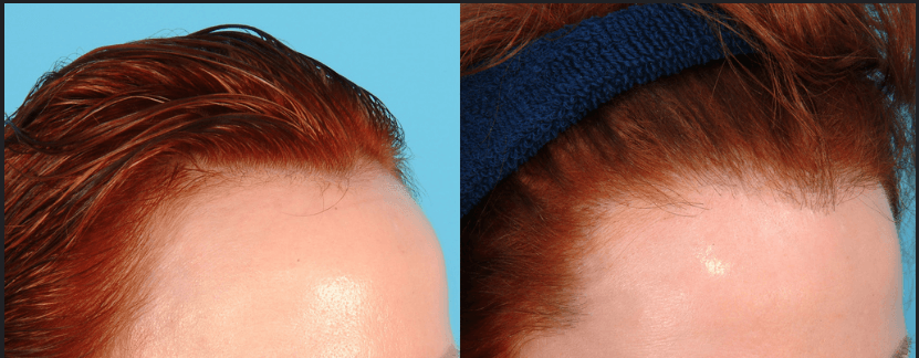 تصغير الجبهة من خلال زراعة الشعر المباشرة DHI