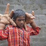 طفل-ذو-اعاقة في الهند