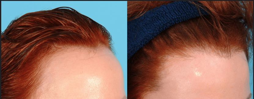 زراعة الشعر المباشرة DHI بهدف تصغير الجبهة