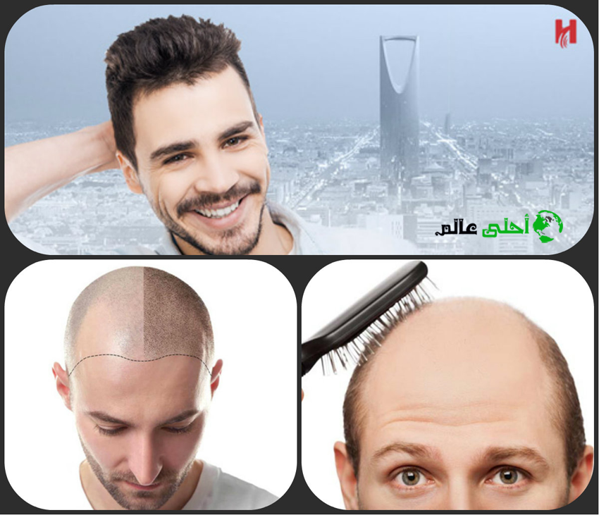 زراعة الشعر, زراعة الحواجب, زراعة الرموش, طرق زراعة الشعر. عملية زراعة الشعر, أحلى عالم